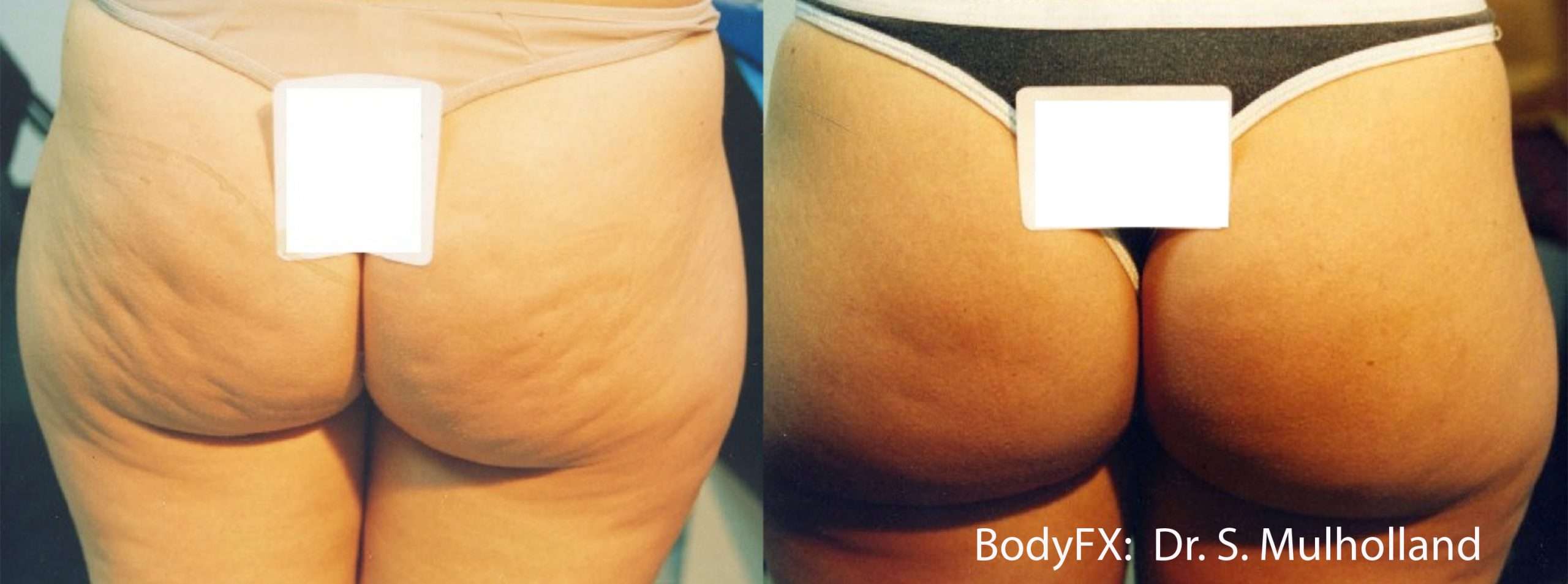 Vorher / Nachher Inmode